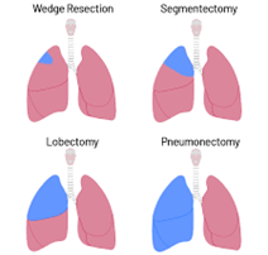 Lung Cancer Treatment Options & Recovery | Saint John's Cancer Institute