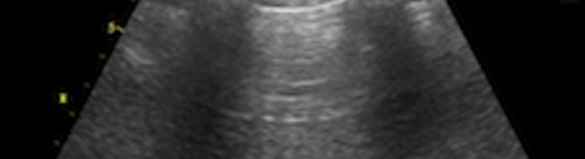 Lung Ultrasound